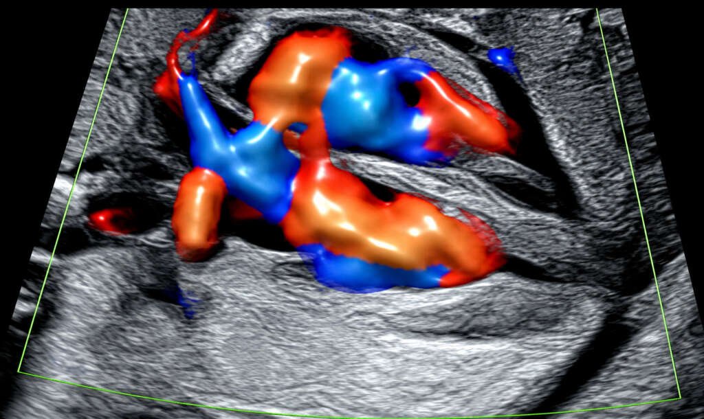 ECOCARDIOGRAFÍA FETAL