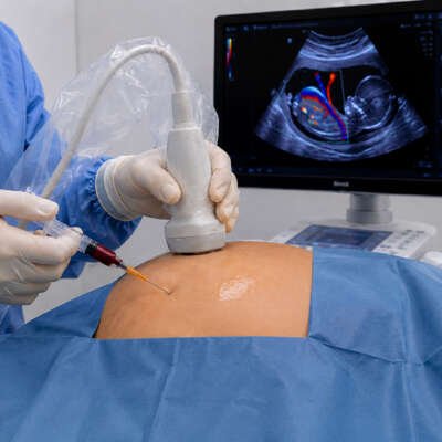 cordocentesis